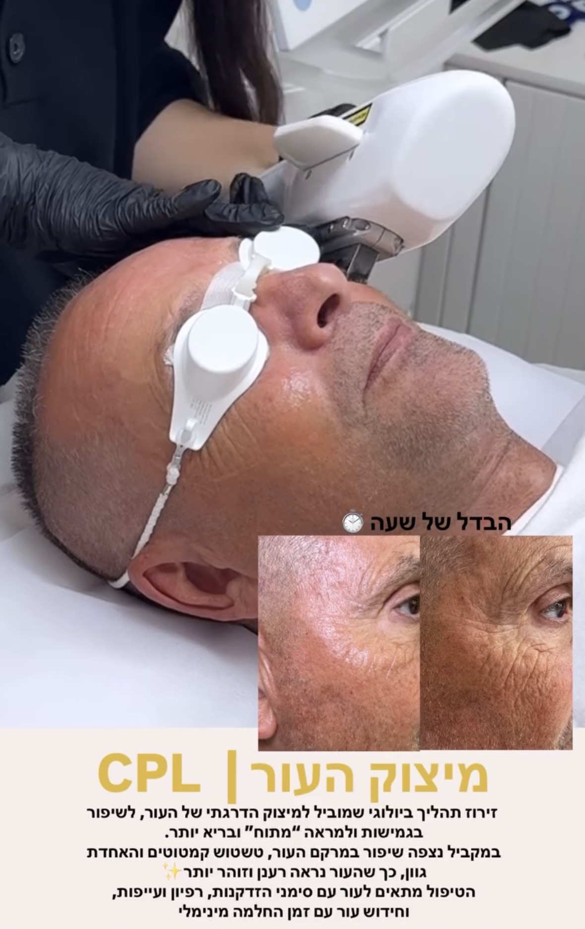 מיצוק העור CPL במהלך הטיפול