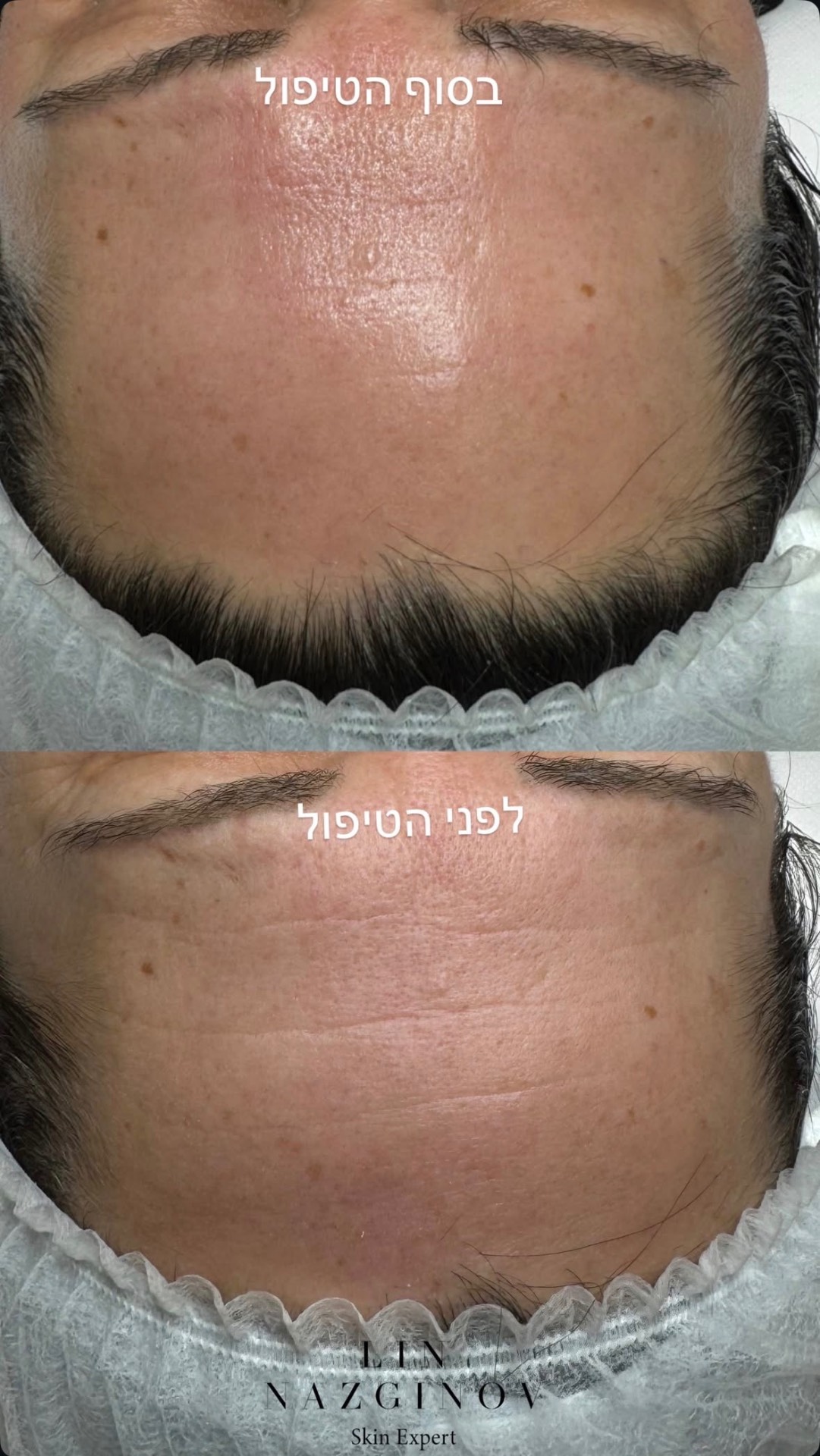 טשטוש קמטוטים במצח, לפני ואחרי